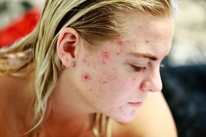 El acné afecta a una gran parte de la población mundial y a más mujeres-min.