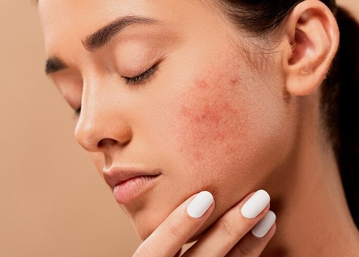 How can CBD relieve hives?