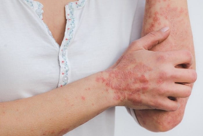 Hemp Oil and CBD Can Relieve Psoriasis: Here's How
